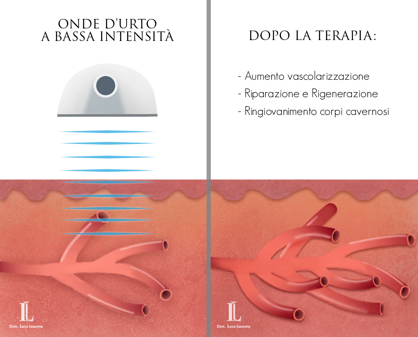 Onde d'urto a bassa intensità: trattamento innovativo per la cura della Disfunzione Erettile